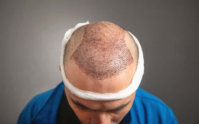 Hair Transplant in Dubai
