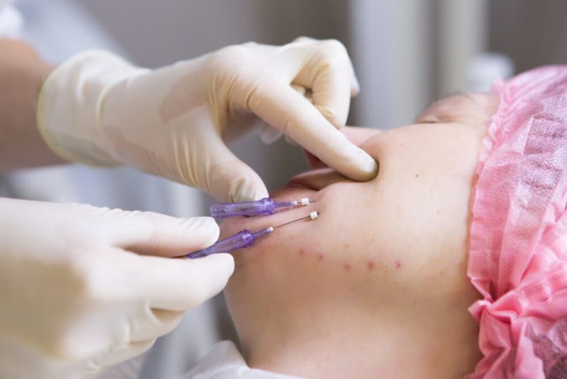 Silhouette Soft Thread Lift in Dubai