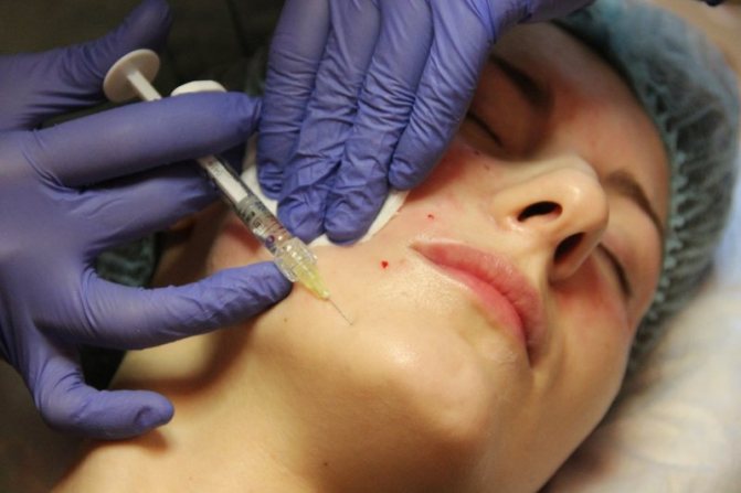 Vampire Facial in Dubai