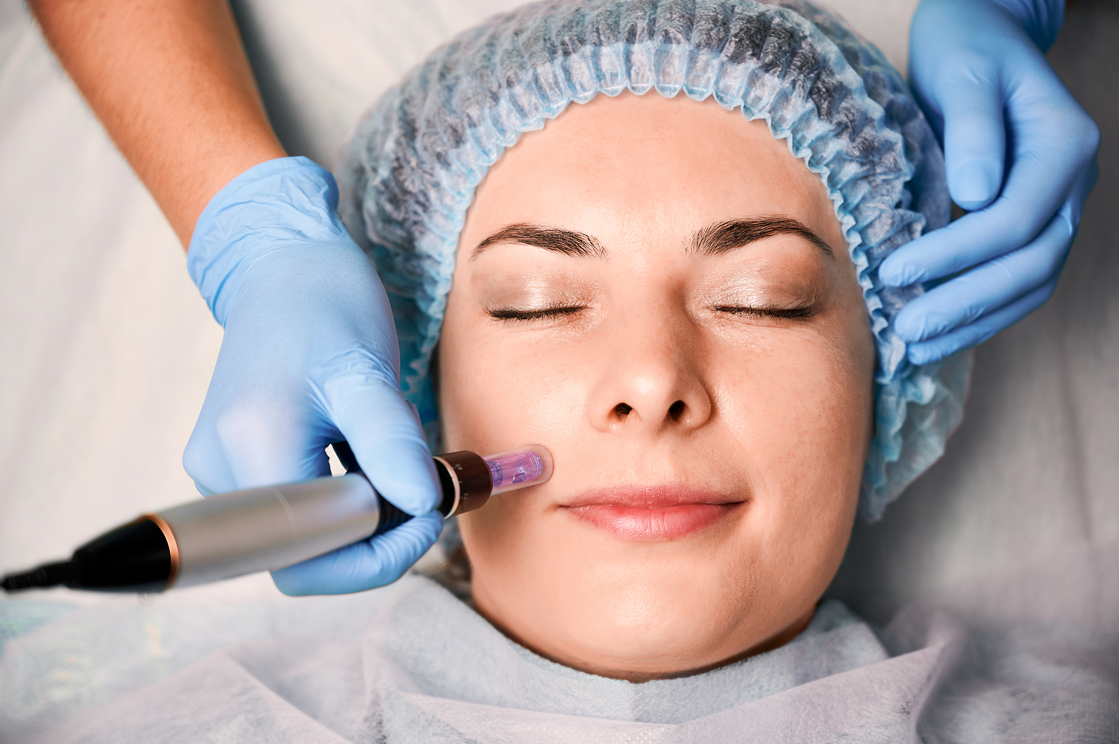 RF Microneedling in Dubai